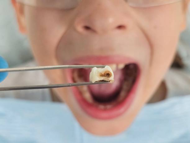 Best Tooth Infection Emergency Dentist  in Hyattsville, MD